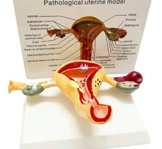 Female Pathological Uterus Anatomy Model 3D 1